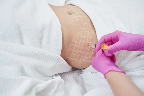 image of fat dissolving injections on love handles to help combat weight gain Gilmerton
