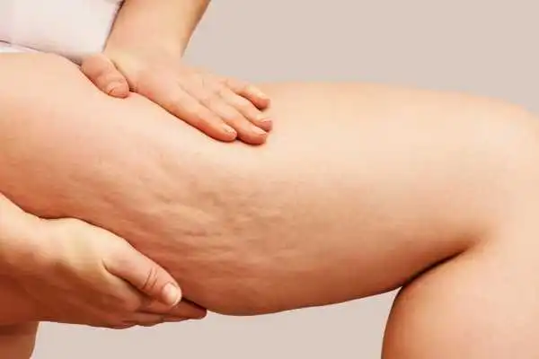 Image of woman showing leg with cellulite Gilmerton