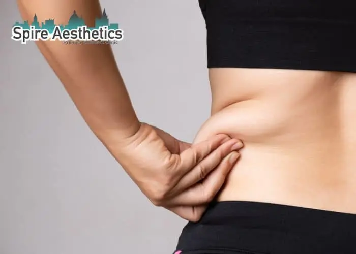 Image of woman pinching fat on their hips Gilmerton. Fat Freezing treatment