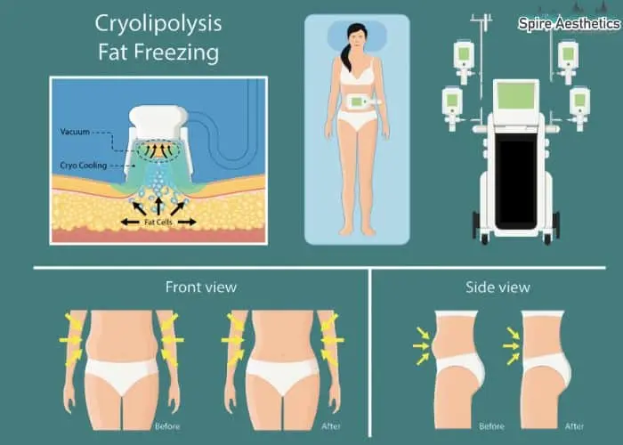 Fat freezing treatment Gilmerton benefits for competitions to remove stubborn fat deposits.