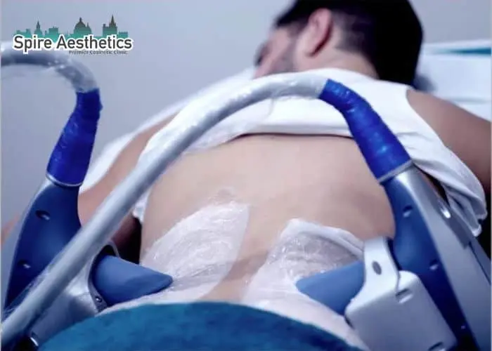 Man having fat freezing treatment done on love handles before a competitions Gilmerton to create a sculpted look.