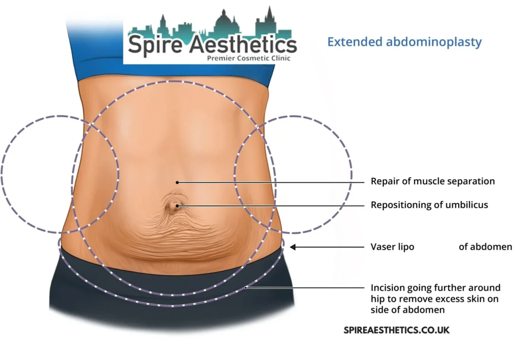 Understanding Loose Skin After Gastric Band Gilmerton Surgery and HIFU Treatment