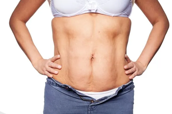 sagging skin on woman's stomach after weight loss injections Gilmerton